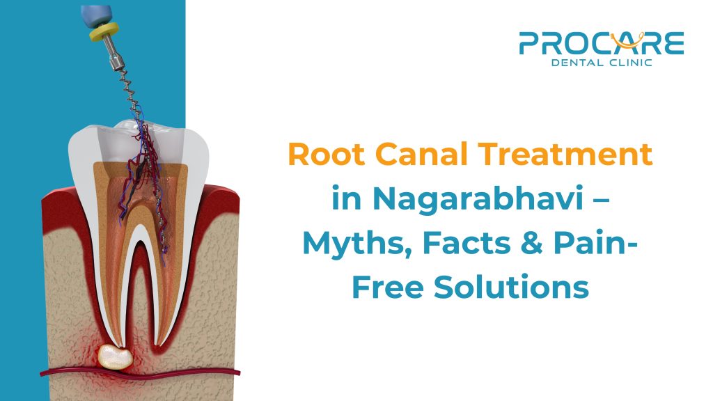 Root Canal Treatment in Banashankari – Myths, Facts & Pain-Free Solutions
